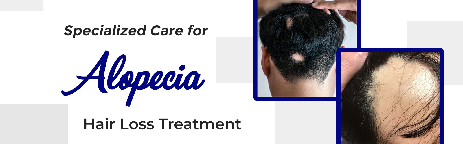 Alopecia Treatment in local